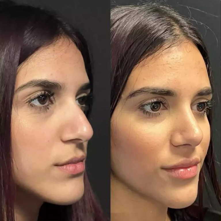 Managing Swelling and Bruising After Rhinoplasty in Dubai