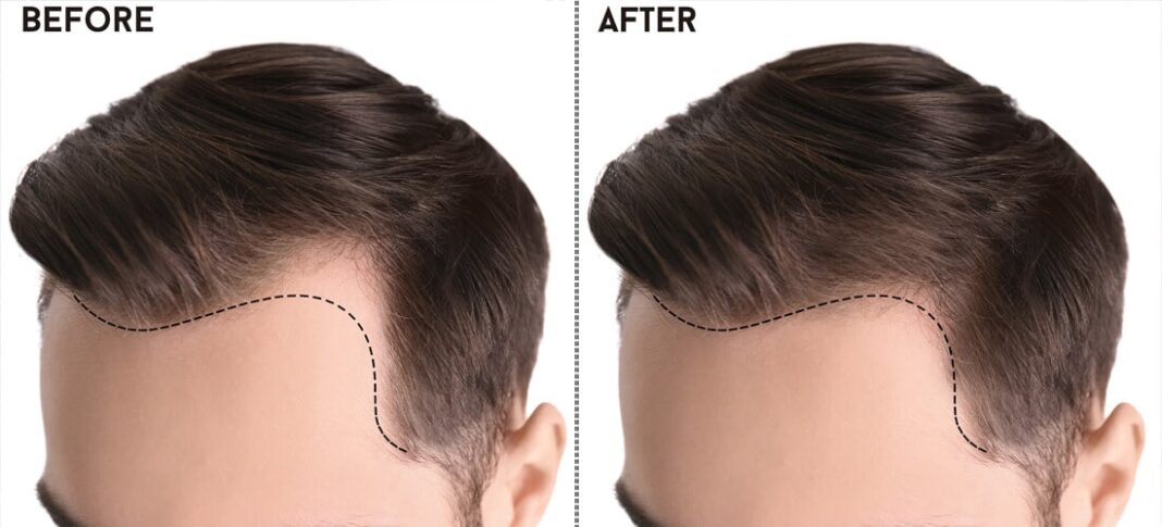 Hair Transplant in Pakistan