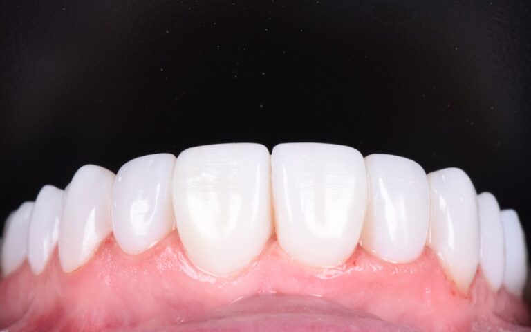 Private Dentist Hertfordshire: High-Quality Composite