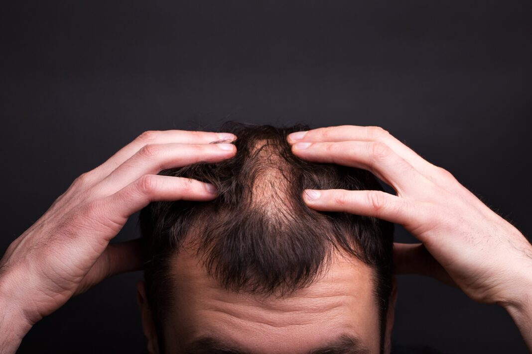 hair loss treatment in islamabad