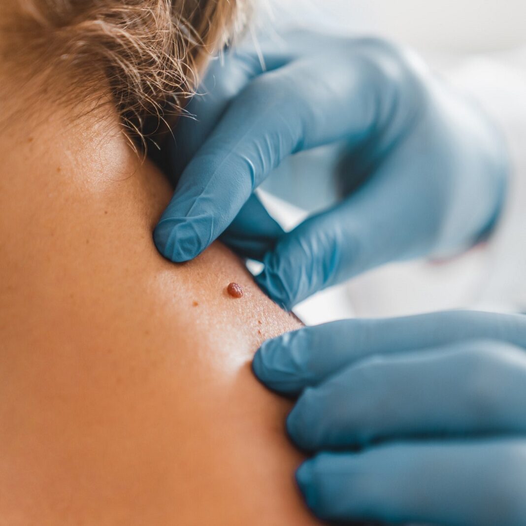 Skin Tag Removal Guide: Quick Solution For Smooth Skin