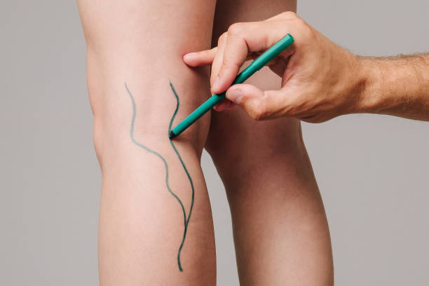 How Effective Are Spider Veins Treatments?