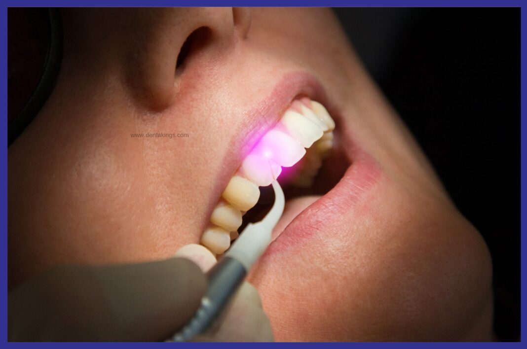 Laser Gum Treatment