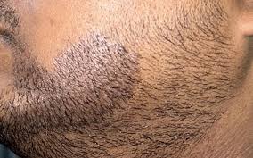 Who Can Benefit from a Beard Hair Transplant?