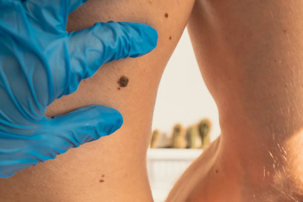 Who is a Suitable Candidate for Laser Birthmark Removal?