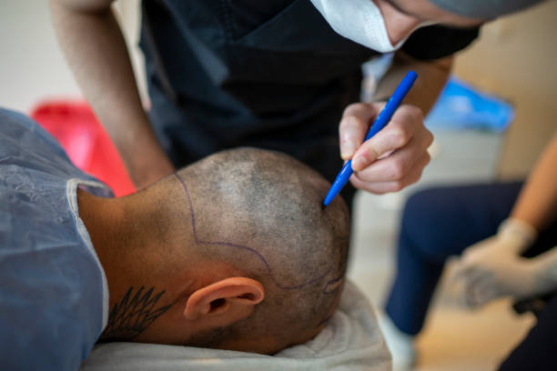 Why Everyone Is Talking About Hair Transplant Cost Right Now