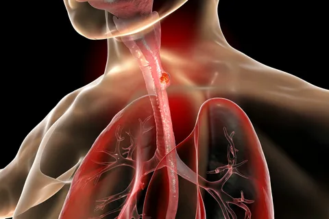 Esophageal Cancer Cough Treatment