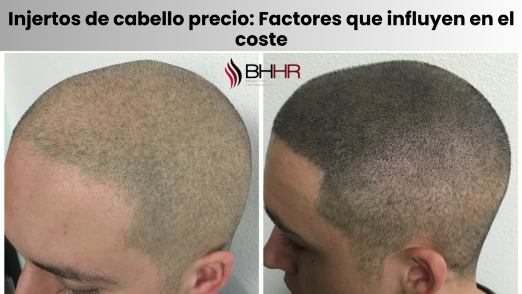 injertos de cabello precio