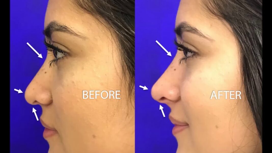 Liquid Rhinoplasty